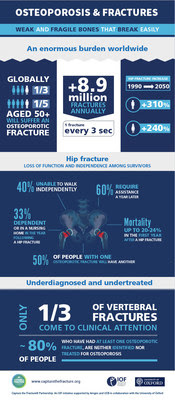 Despite its serious outcomes, osteoporosis remains vastly underdiagnosed and undertreated, particularly among individuals who have already broken a bone, and who are at high risk of suffering further fractures. The Capture the Fracture® Partnership aims to proactively implement post-fracture care coordination programs in hospitals and healthcare systems, to help prevent subsequent fractures due to osteoporosis, and improve patient care. Despite its serious outcomes, osteoporosis remains vastly underdiagnosed and undertreated, particularly among individuals who have already broken a bone, and who are at high risk of suffering further fractures. The Capture the Fracture® Partnership aims to proactively implement post-fracture care coordination programs in hospitals and healthcare systems, to help prevent subsequent fractures due to osteoporosis, and improve patient care.